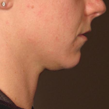 Ultherapy® - Chin: Patient 15 - Before