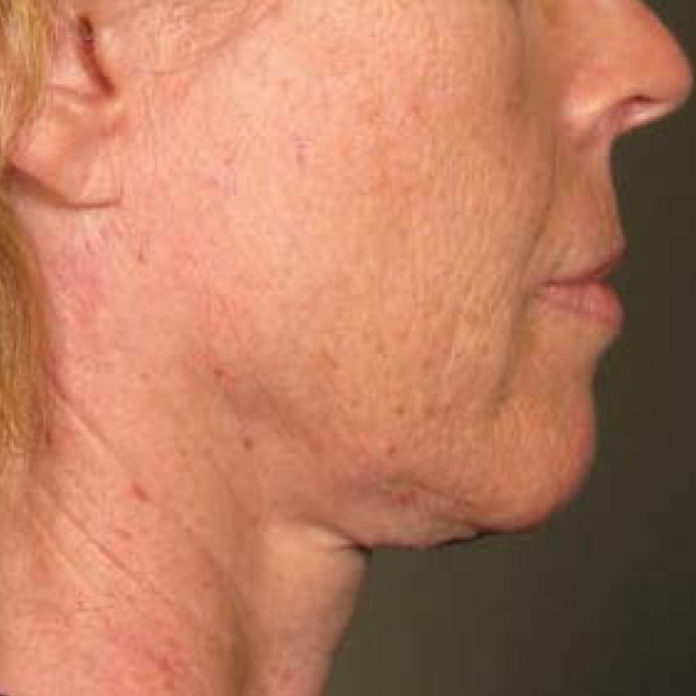 Ultherapy® - Chin: Patient 32 - Before 1