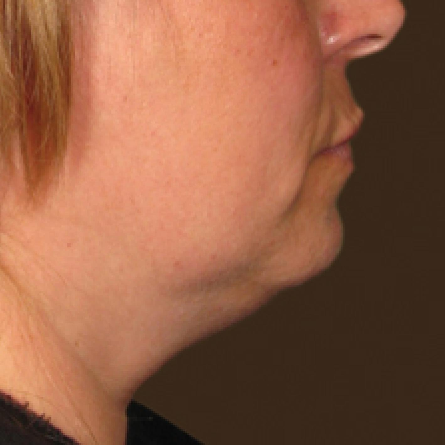 Ultherapy® - Chin: Patient 8 - Before 
