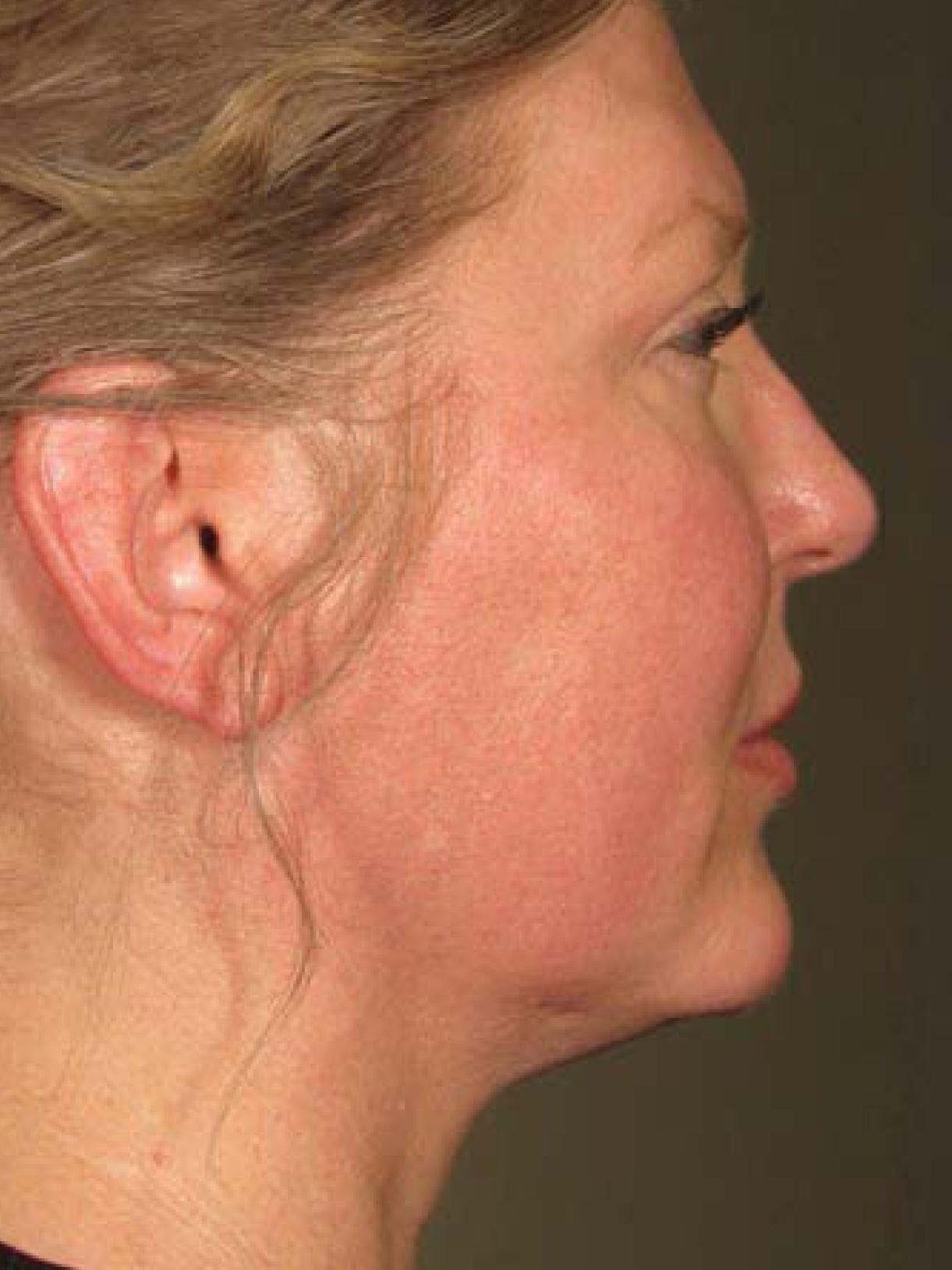 Ultherapy® - Face: Patient 6 - After  