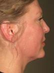 Ultherapy® - Face: Patient 6 - After 
