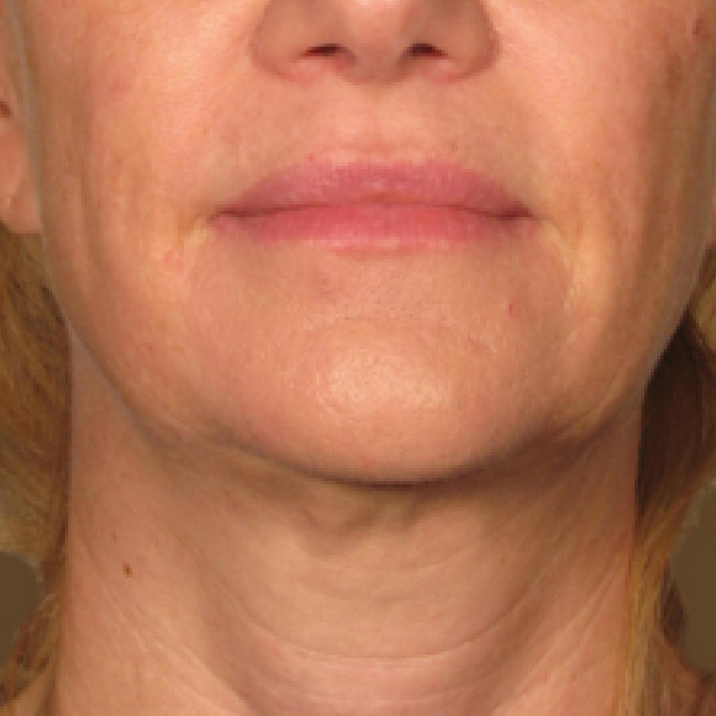 Ultherapy® - Chin: Patient 10 - After 1