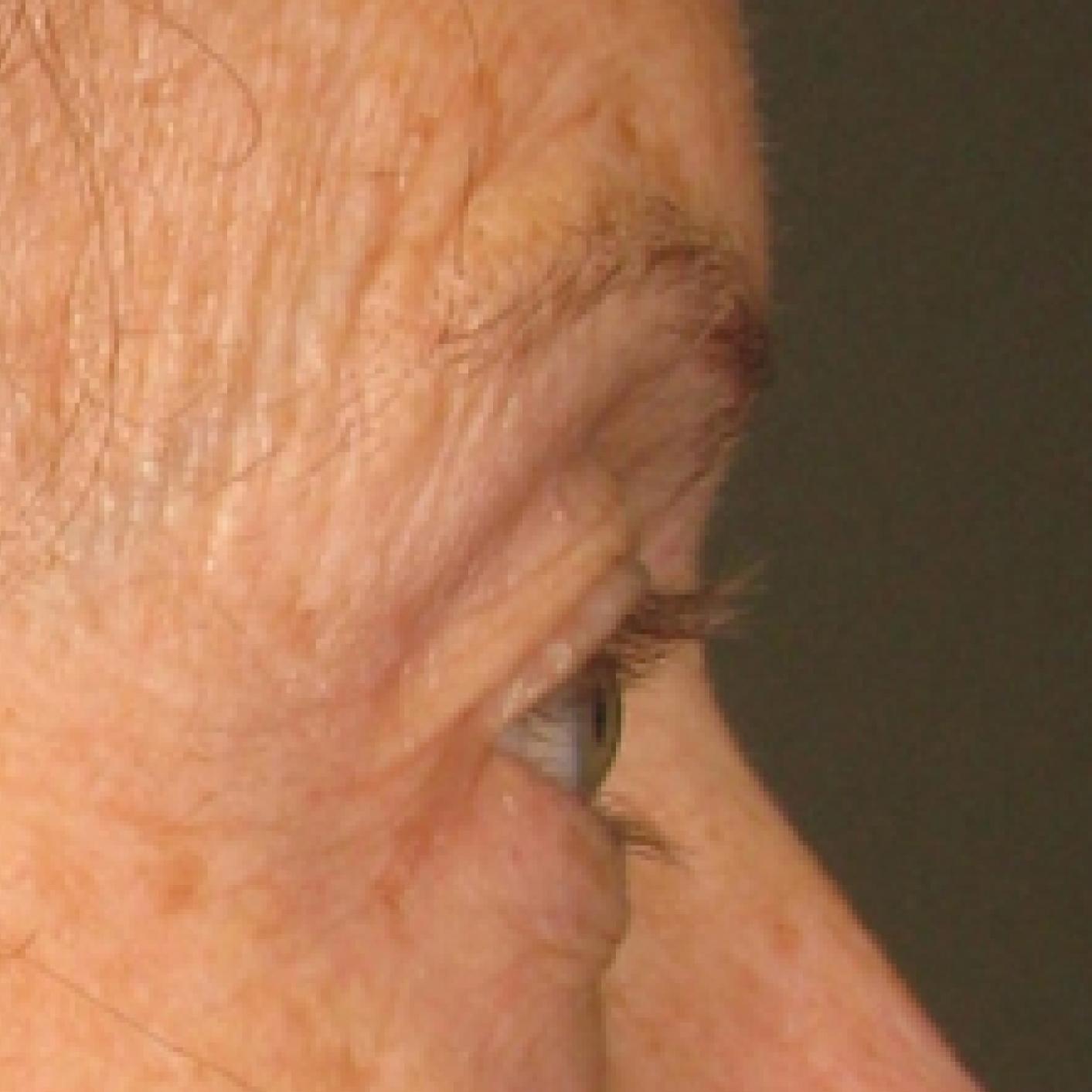 Ultherapy® - Brow: Patient 2 - Before 1