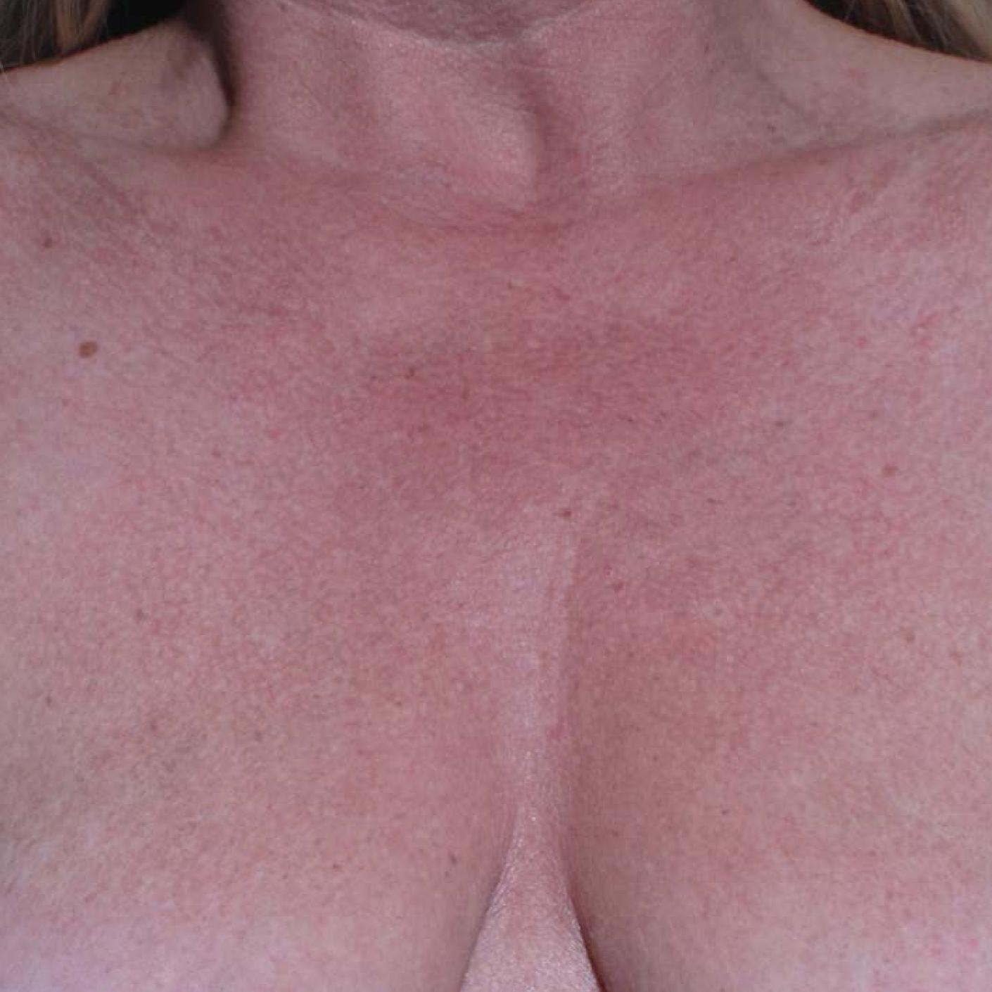 Ultherapy® - Décolletage: Patient 1 - Before 