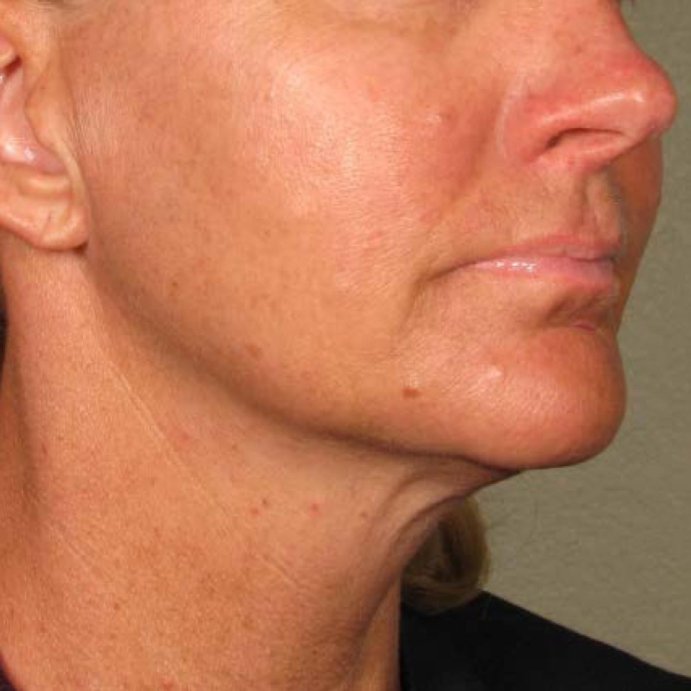 Ultherapy® - Chin: Patient 24 - After 1