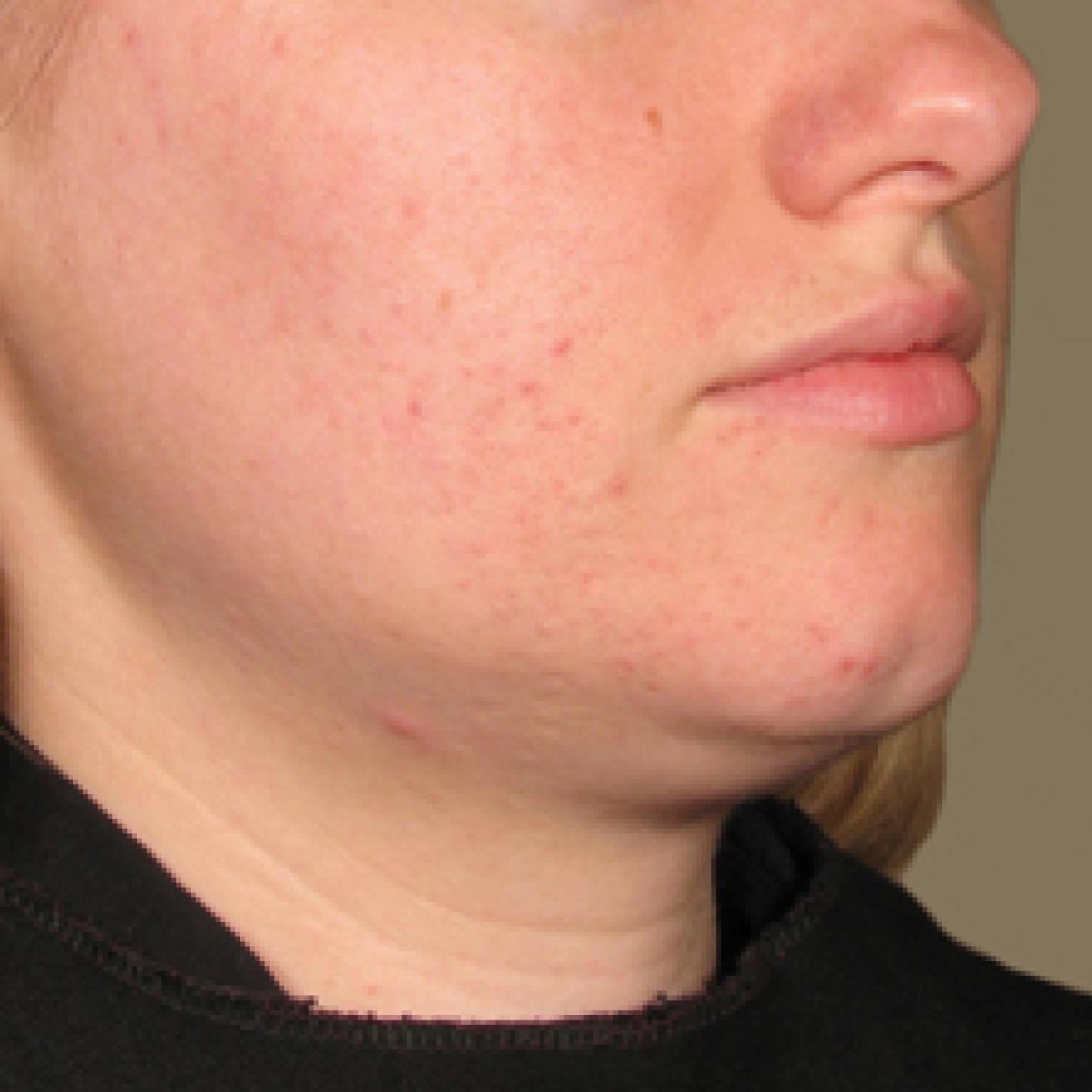 Ultherapy® - Chin: Patient 16 - After 1