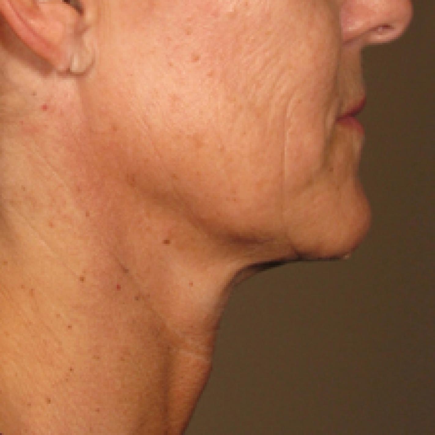 Ultherapy® - Chin: Patient 2 - After 1