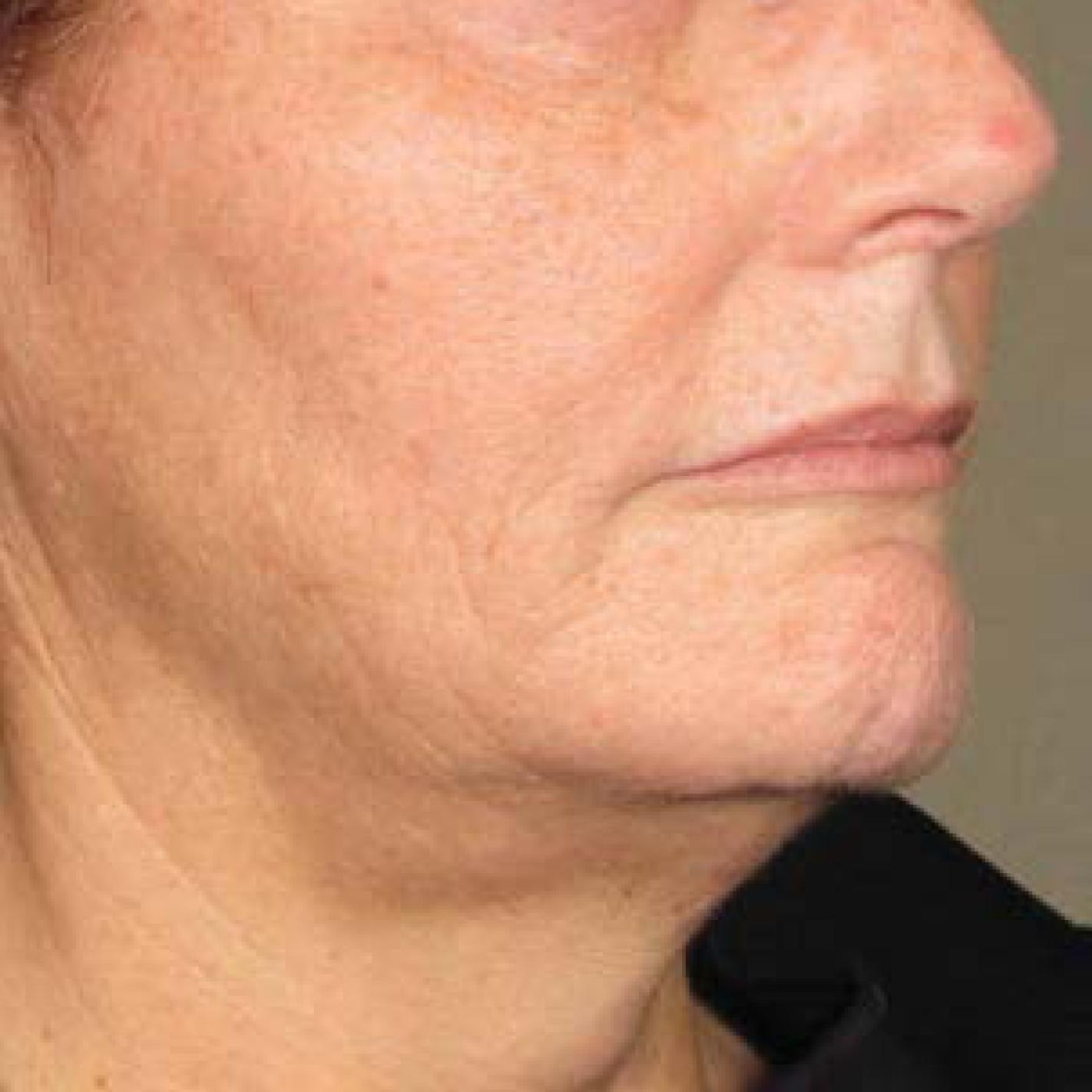 Ultherapy® - Chin: Patient 20 - After 