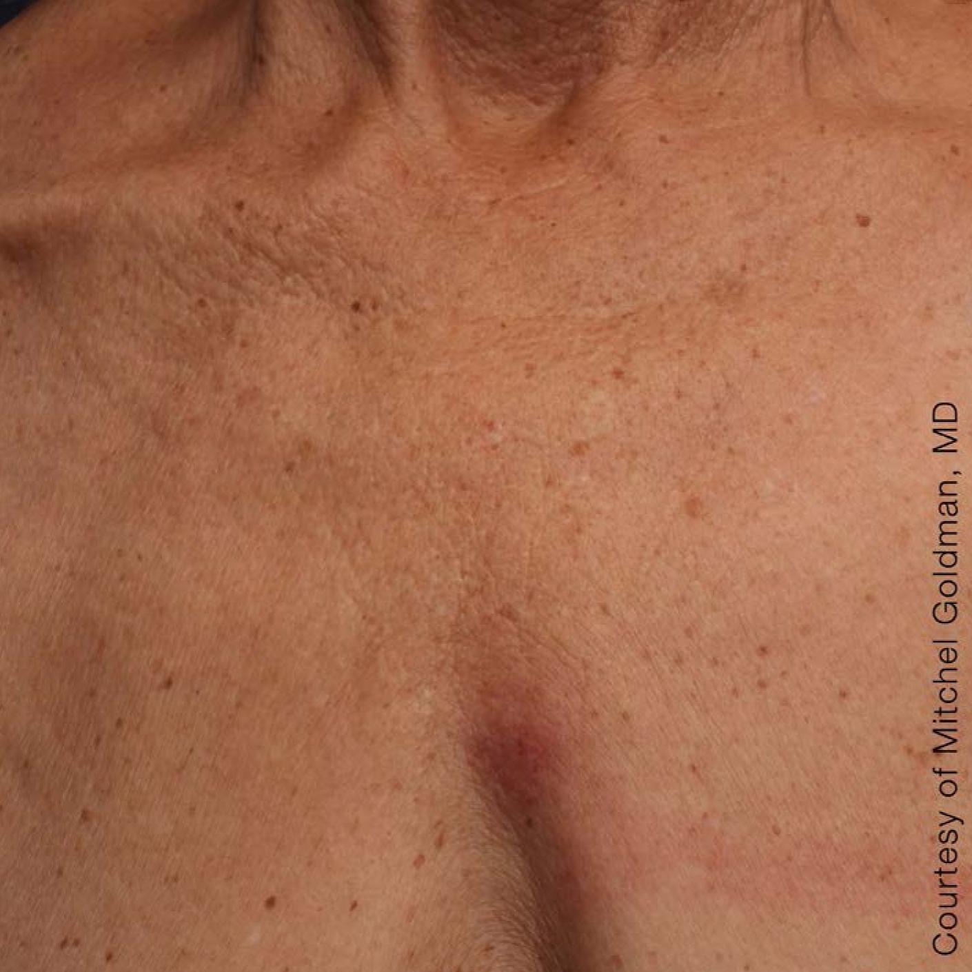 Ultherapy® - Décolletage: Patient 13 - After 