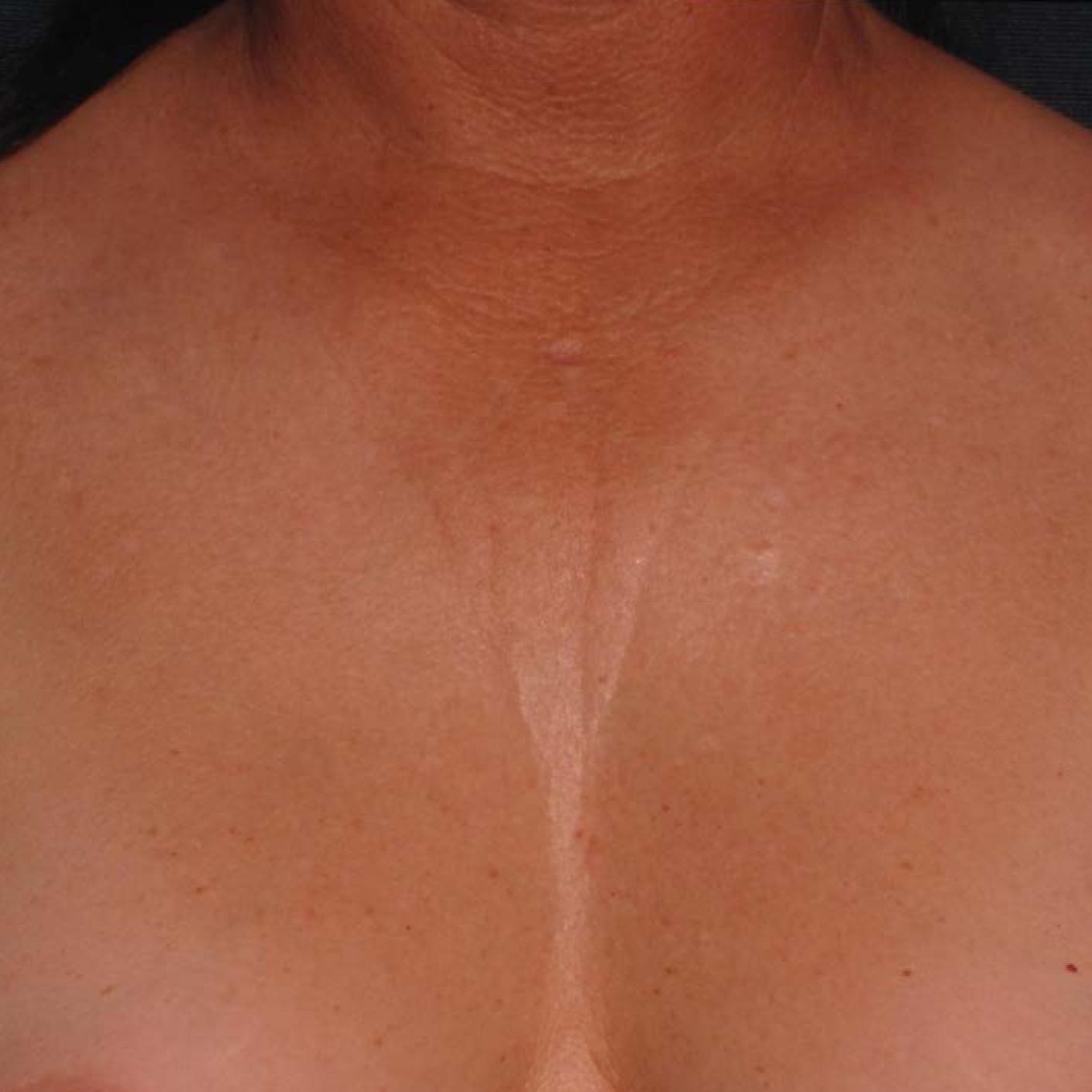 Ultherapy® - Décolletage: Patient 2 - Before 