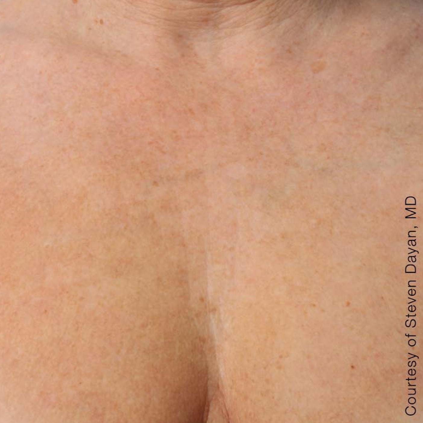 Ultherapy® - Décolletage: Patient 4 - After  