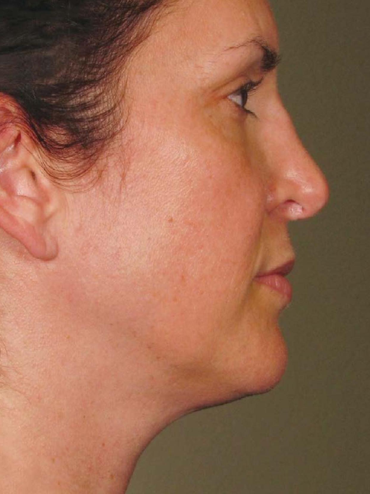 Ultherapy® - Face: Patient 9 - After  