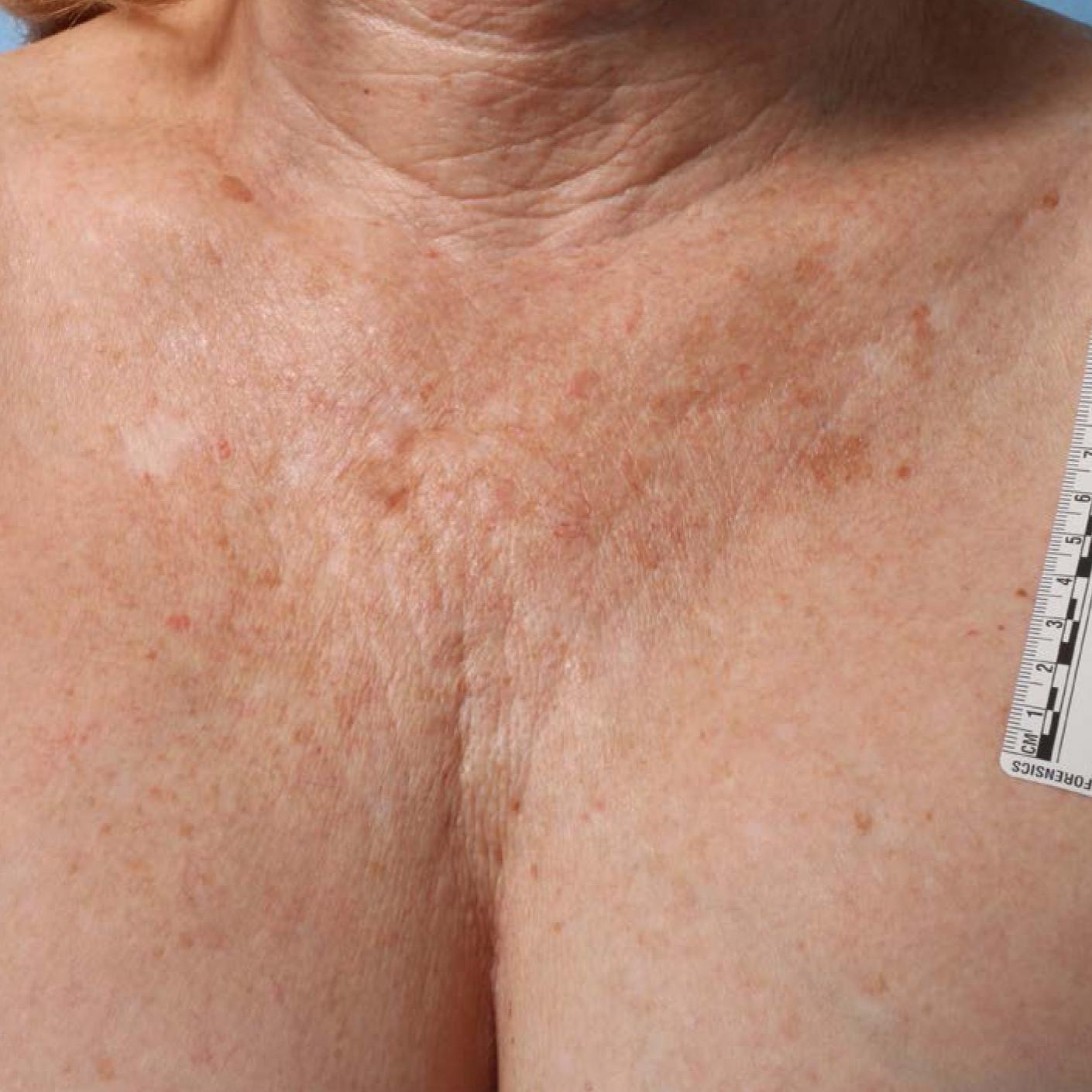 Ultherapy® - Décolletage: Patient 6 - Before 