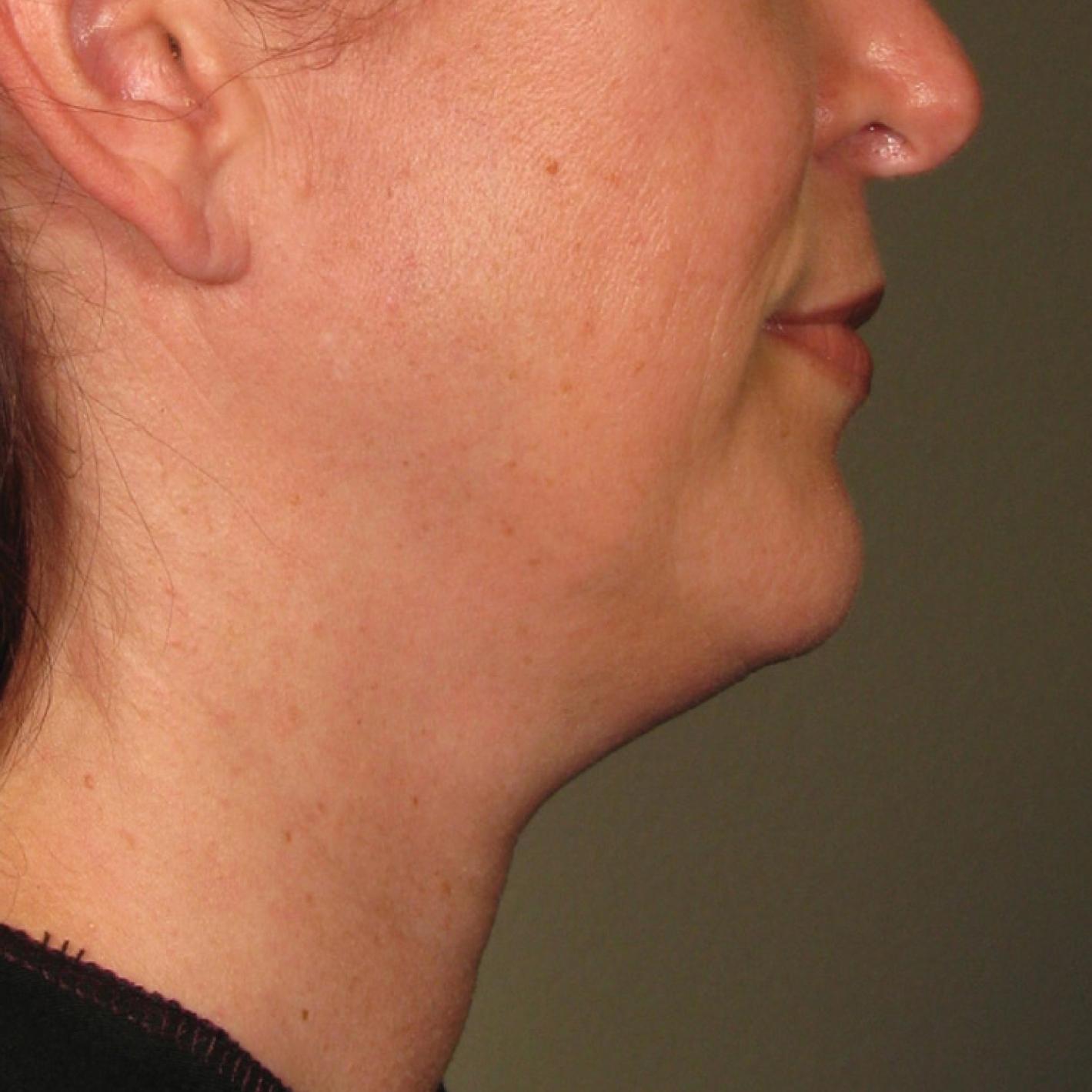 Ultherapy® - Chin: Patient 21 - Before 