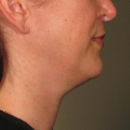 Ultherapy® - Chin: Patient 21 - Before Image