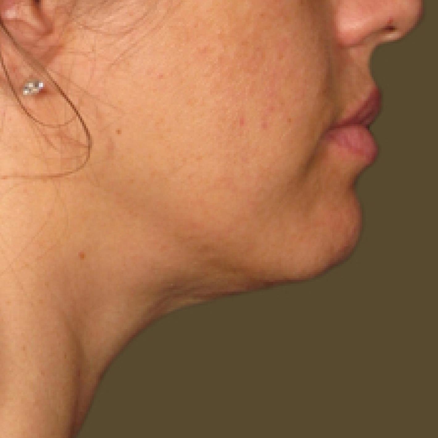 Ultherapy® - Chin: Patient 9 - After  