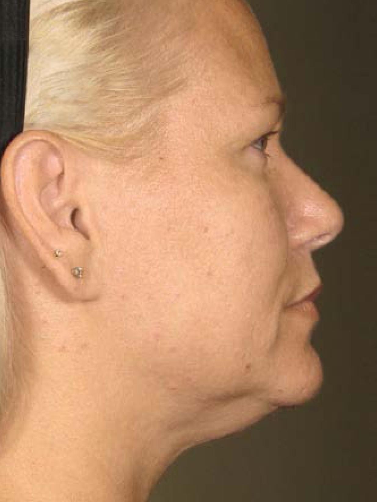 Ultherapy® - Face: Patient 17 - After 