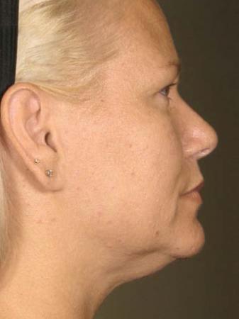 Ultherapy® - Face: Patient 17 - After 1