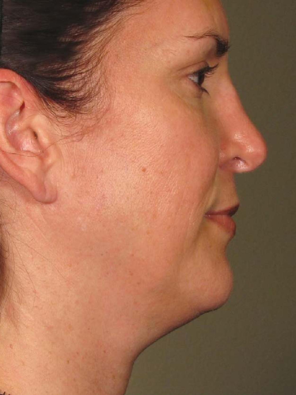 Ultherapy® - Face: Patient 9 - After  