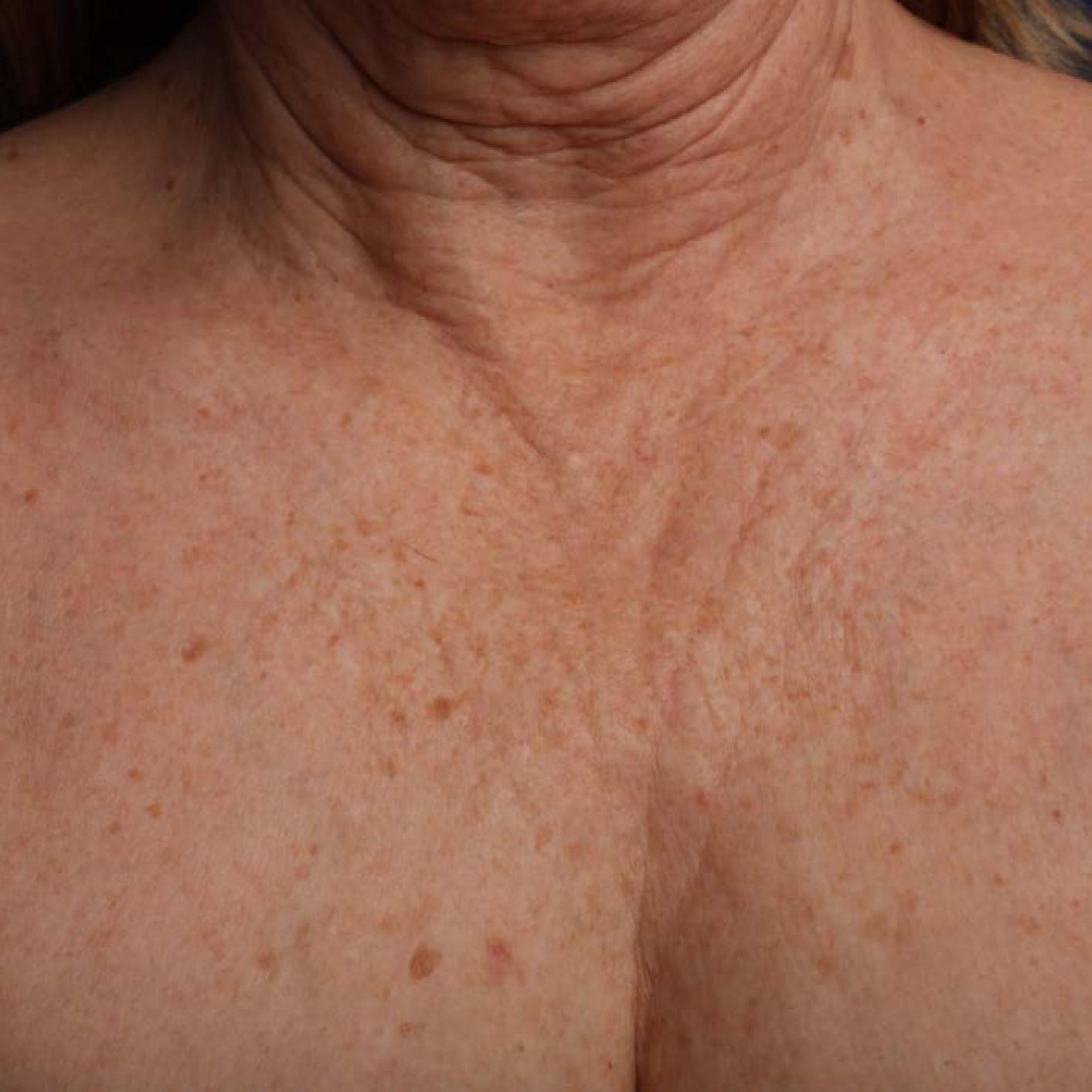 Ultherapy® - Décolletage: Patient 17 - Before 