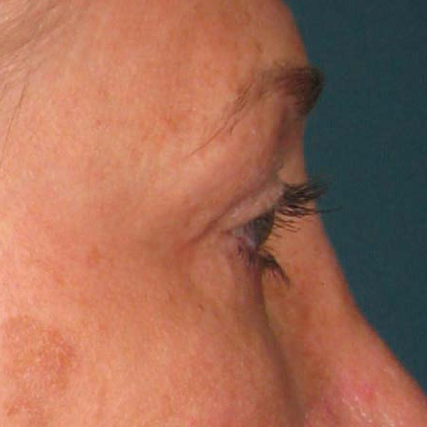 Ultherapy® - Brow: Patient 11 - Before 