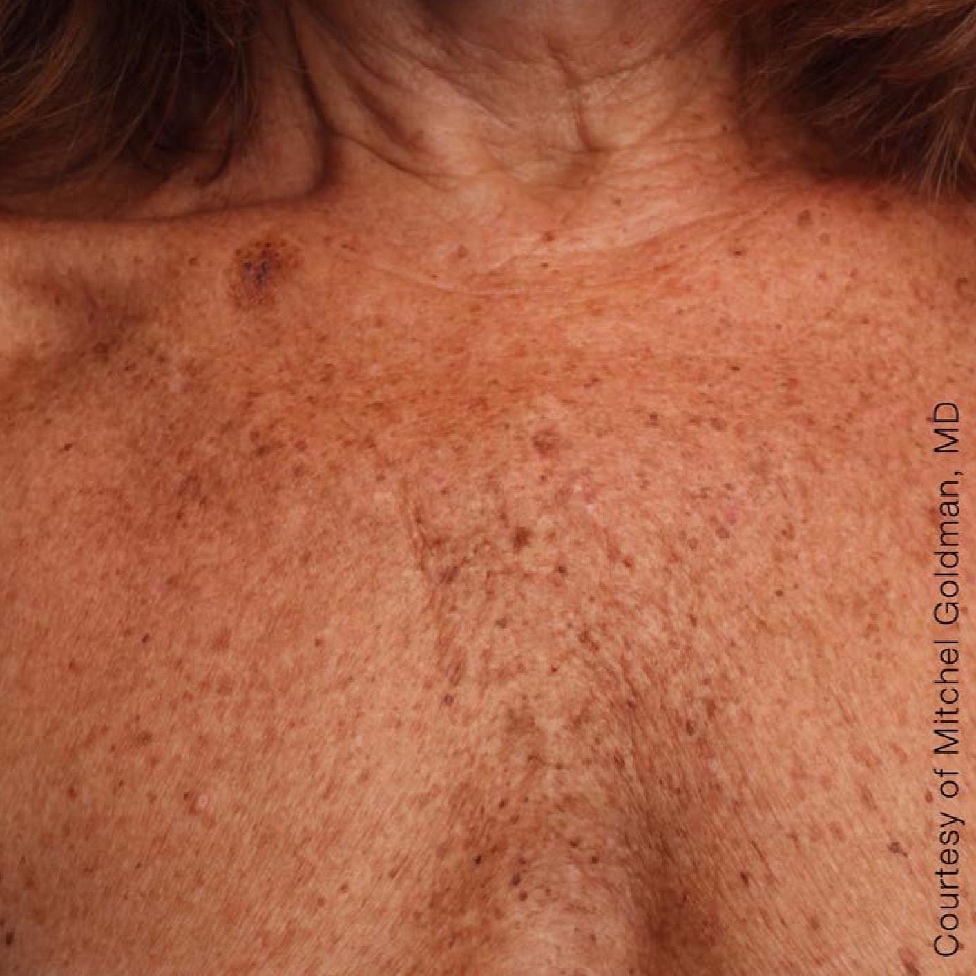 Ultherapy® - Décolletage: Patient 12 - After 