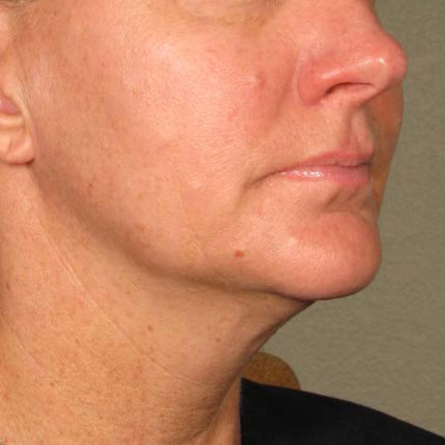 Ultherapy® - Chin: Patient 24 - Before 