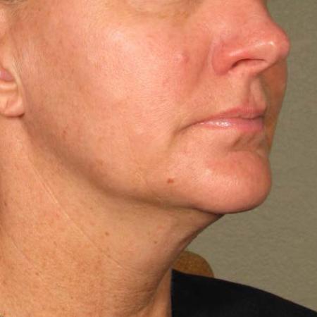 Ultherapy® - Chin: Patient 24 - Before Image