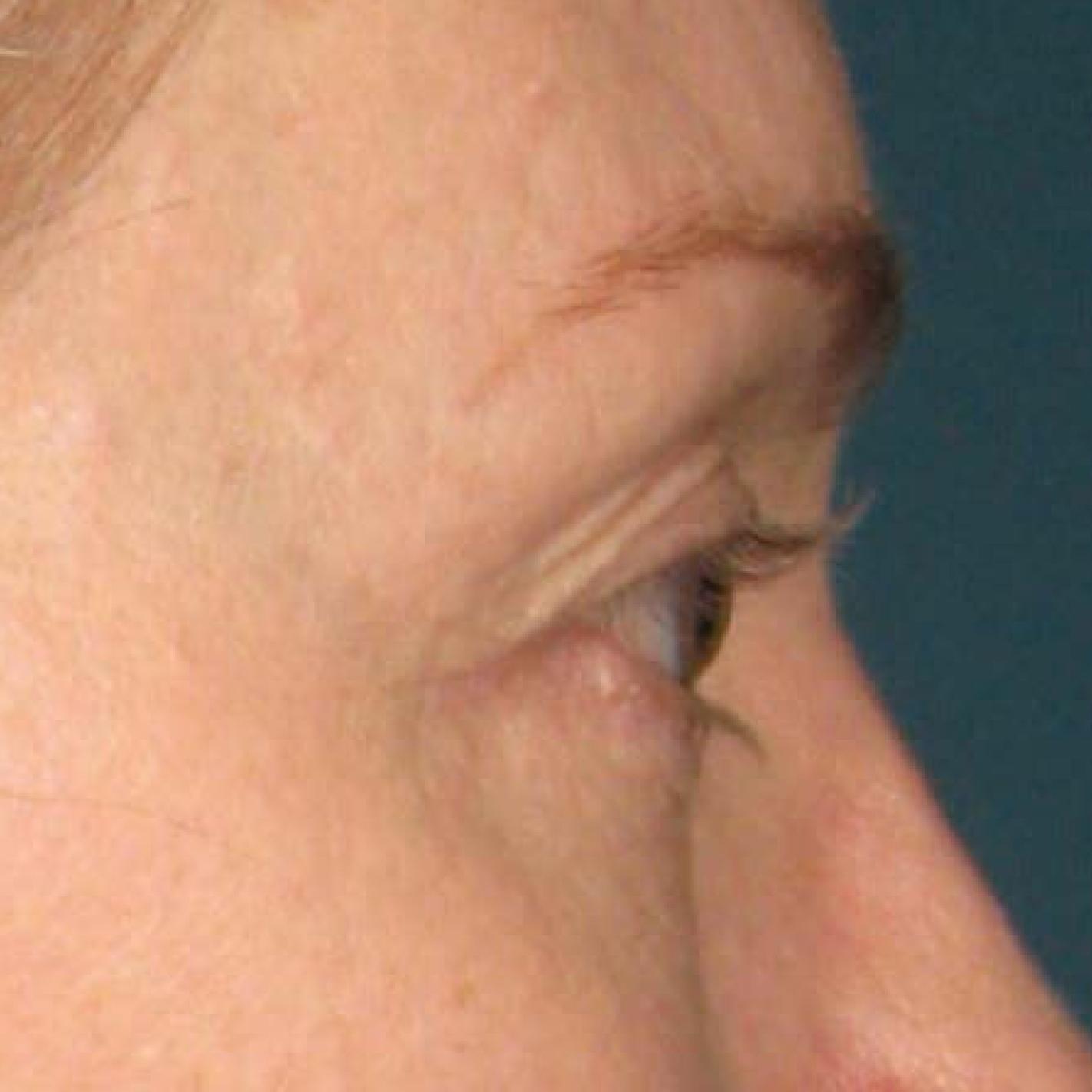 Ultherapy® - Brow: Patient 5 - After  