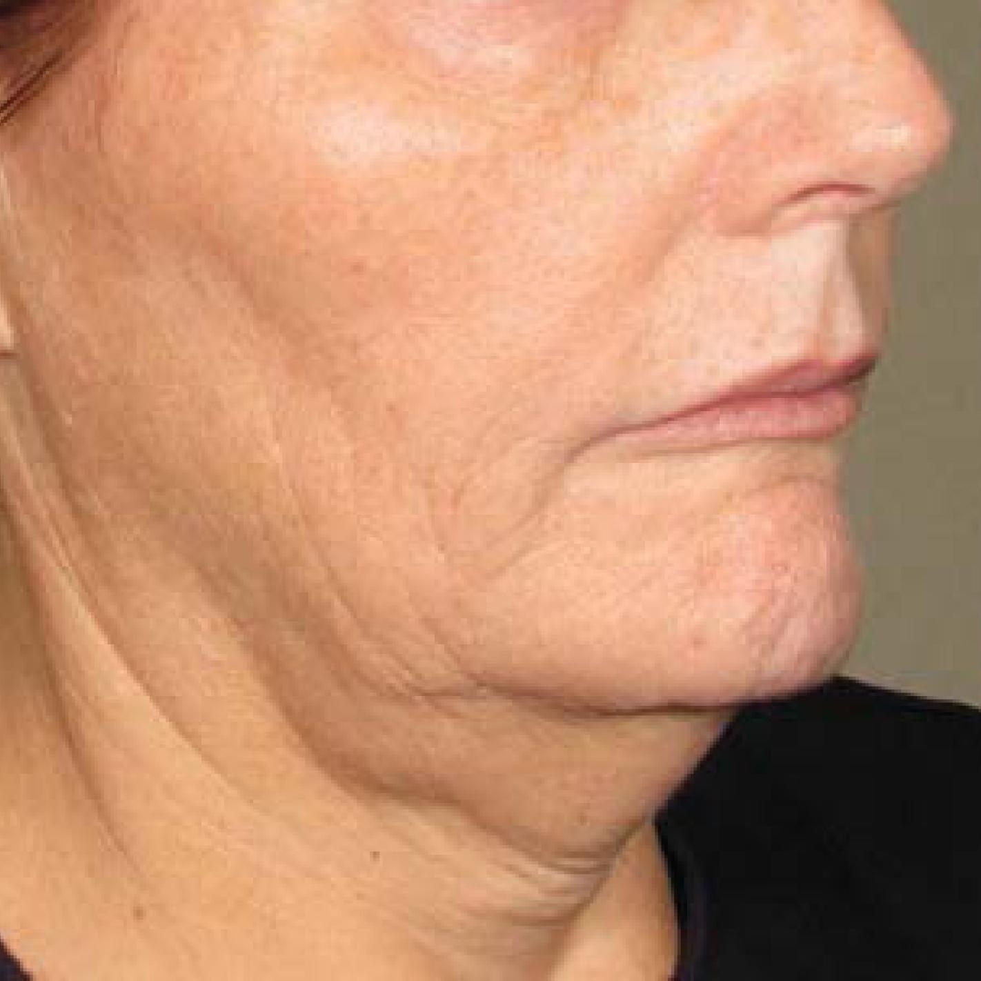 Ultherapy® - Chin: Patient 20 - Before 