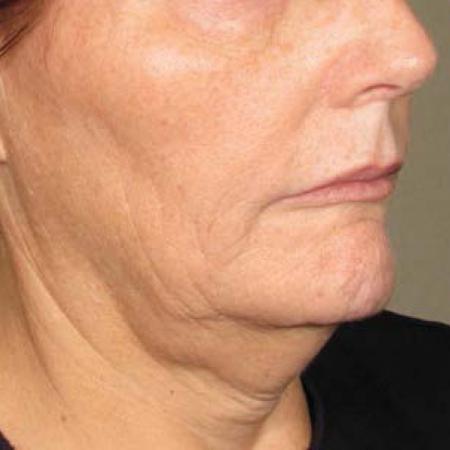 Ultherapy® - Chin: Patient 20 - Before