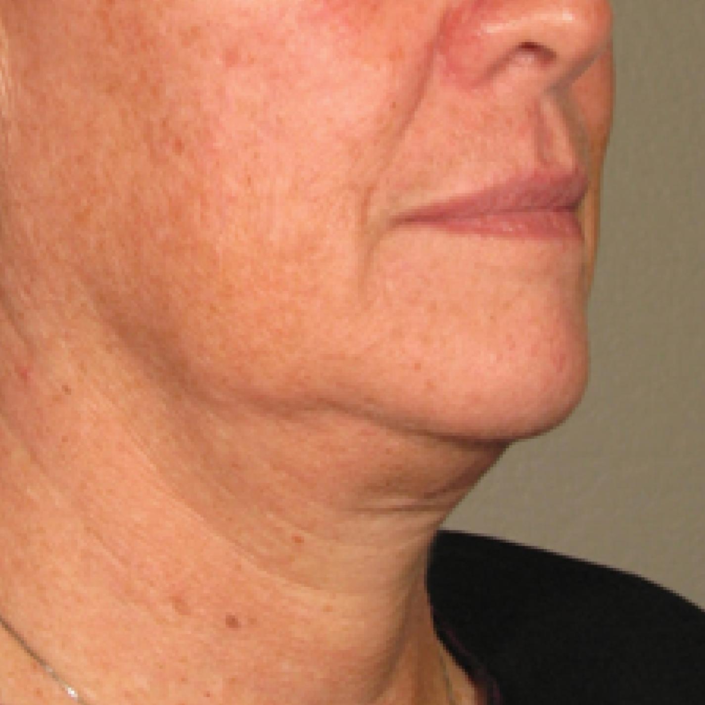 Ultherapy® - Chin: Patient 6 - Before 1