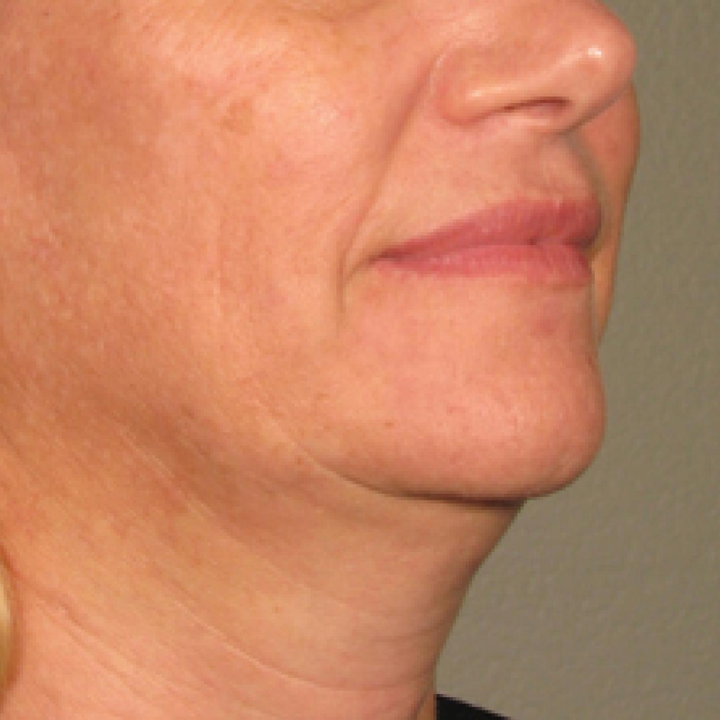 Ultherapy® - Chin: Patient 11 - Before 