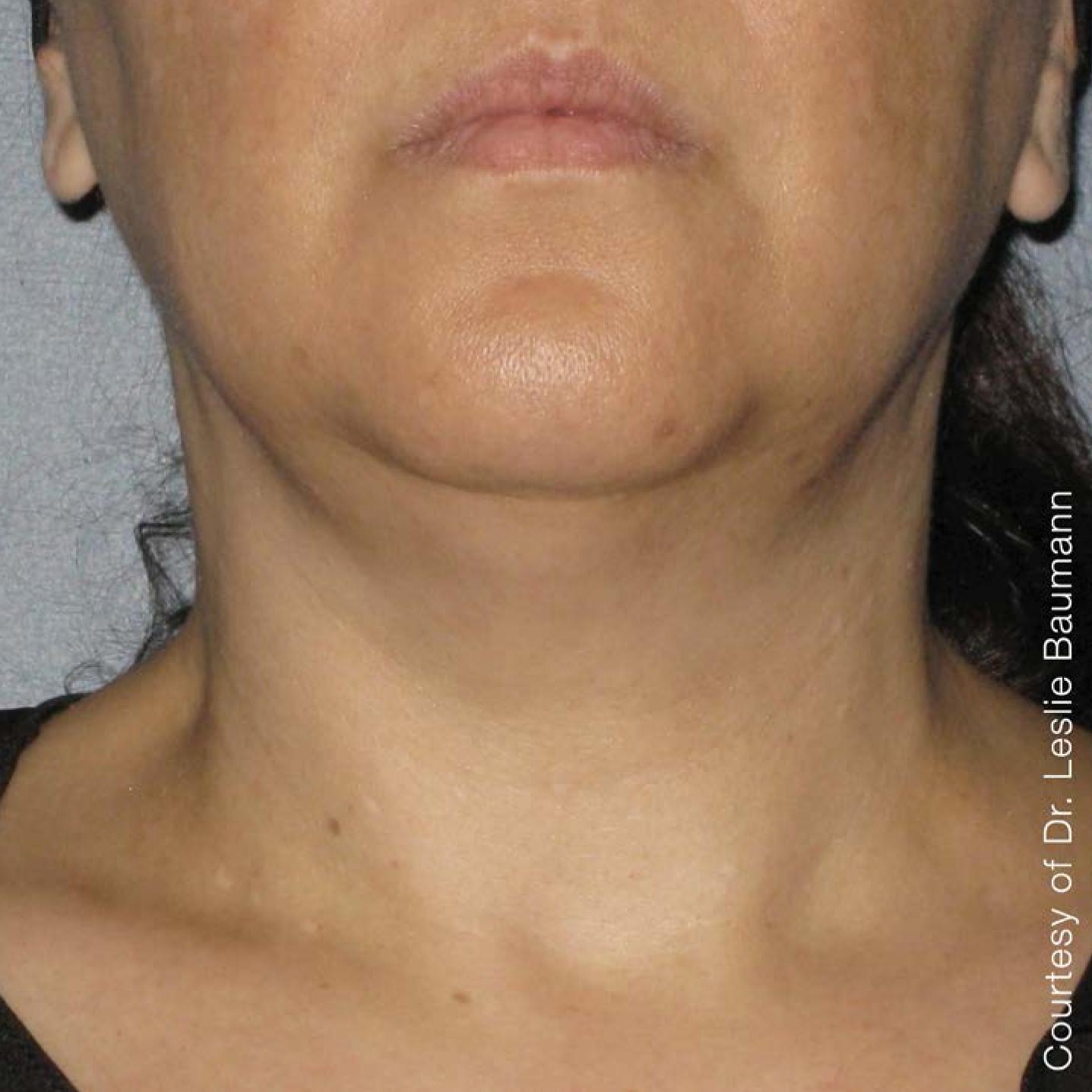 Ultherapy® - Neck: Patient 5 - After  