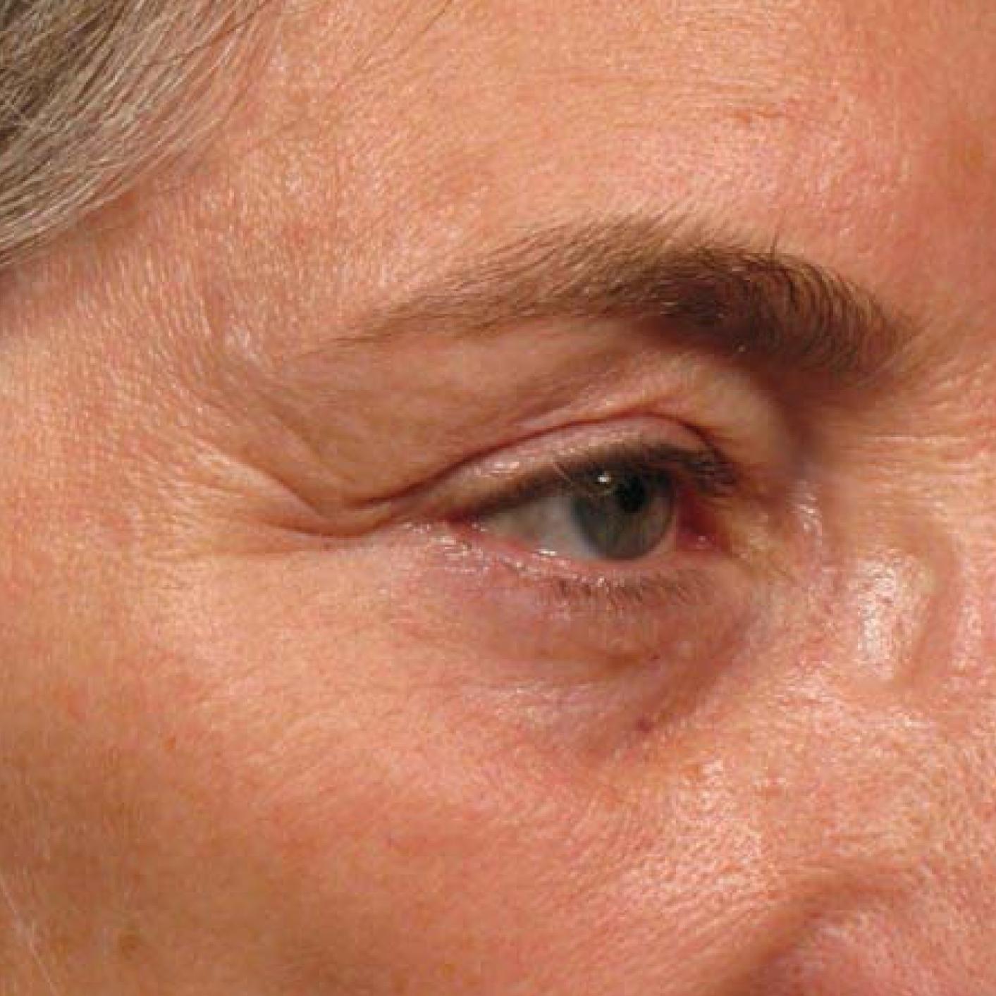 Ultherapy® - Brow: Patient 6 - Before 