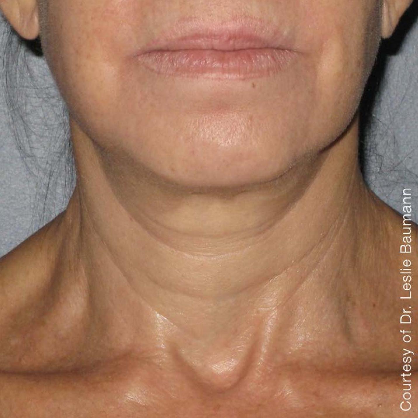 Ultherapy® - Neck: Patient 7 - After  
