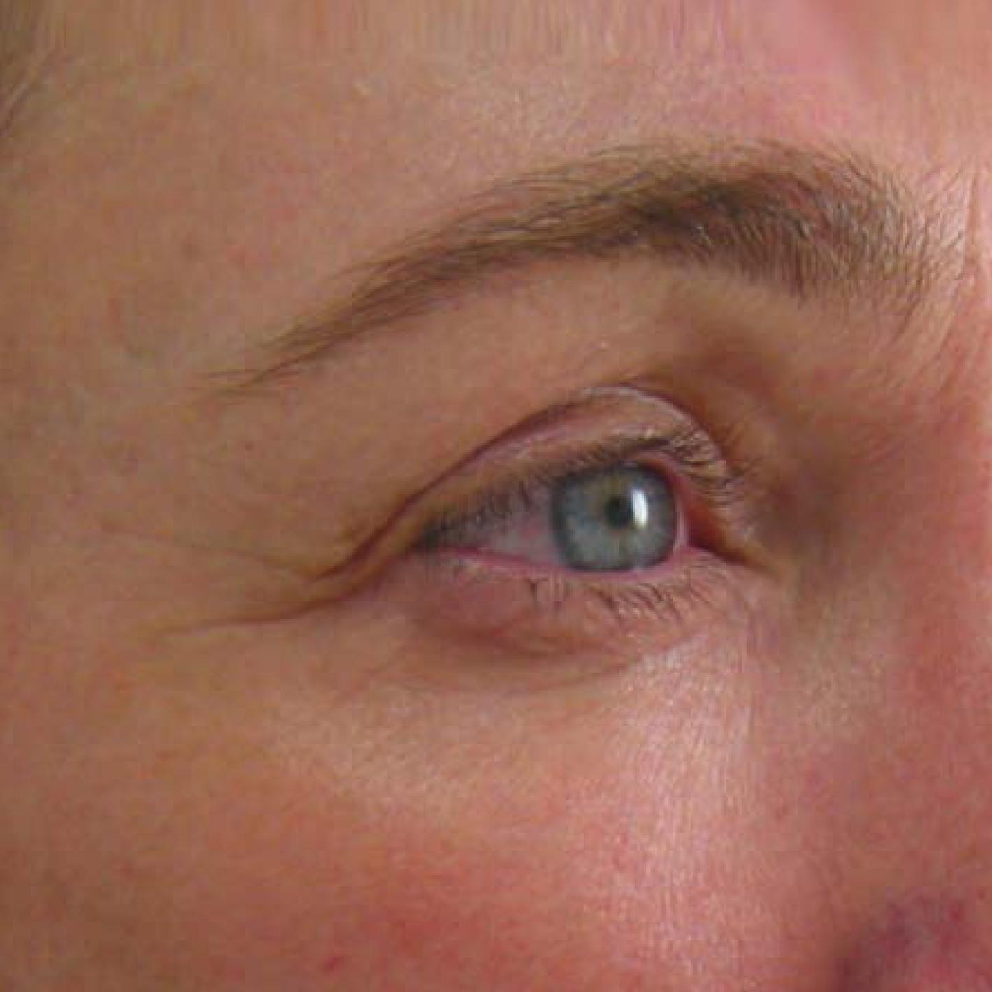 Ultherapy® - Brow: Patient 8 - After  