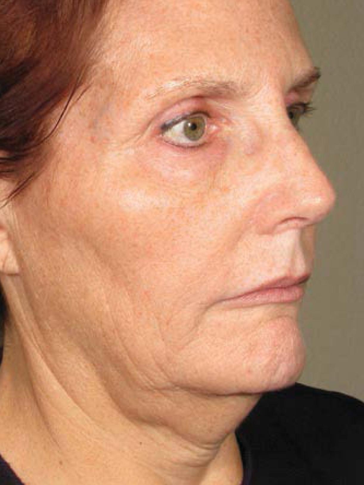 Ultherapy® - Face: Patient 8 - After  