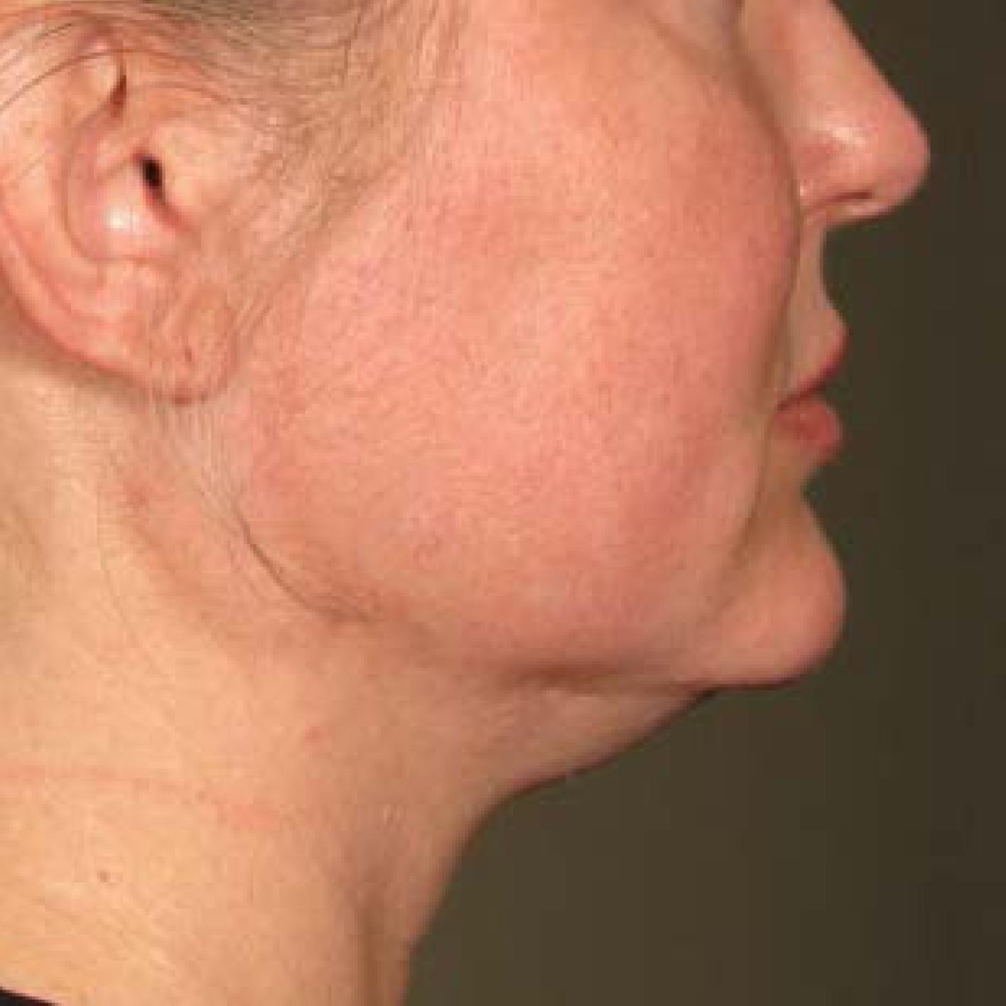 Ultherapy® - Chin: Patient 18 - Before 