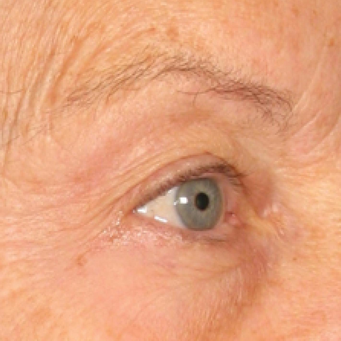 Ultherapy® - Brow: Patient 1 - Before 