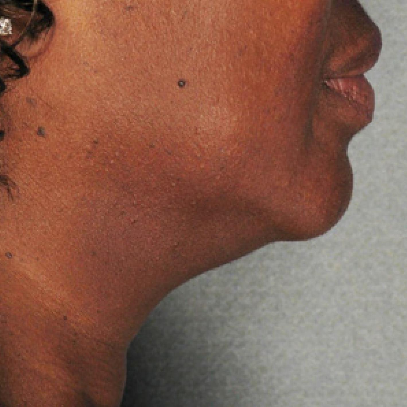 Ultherapy® - Chin: Patient 4 - Before 