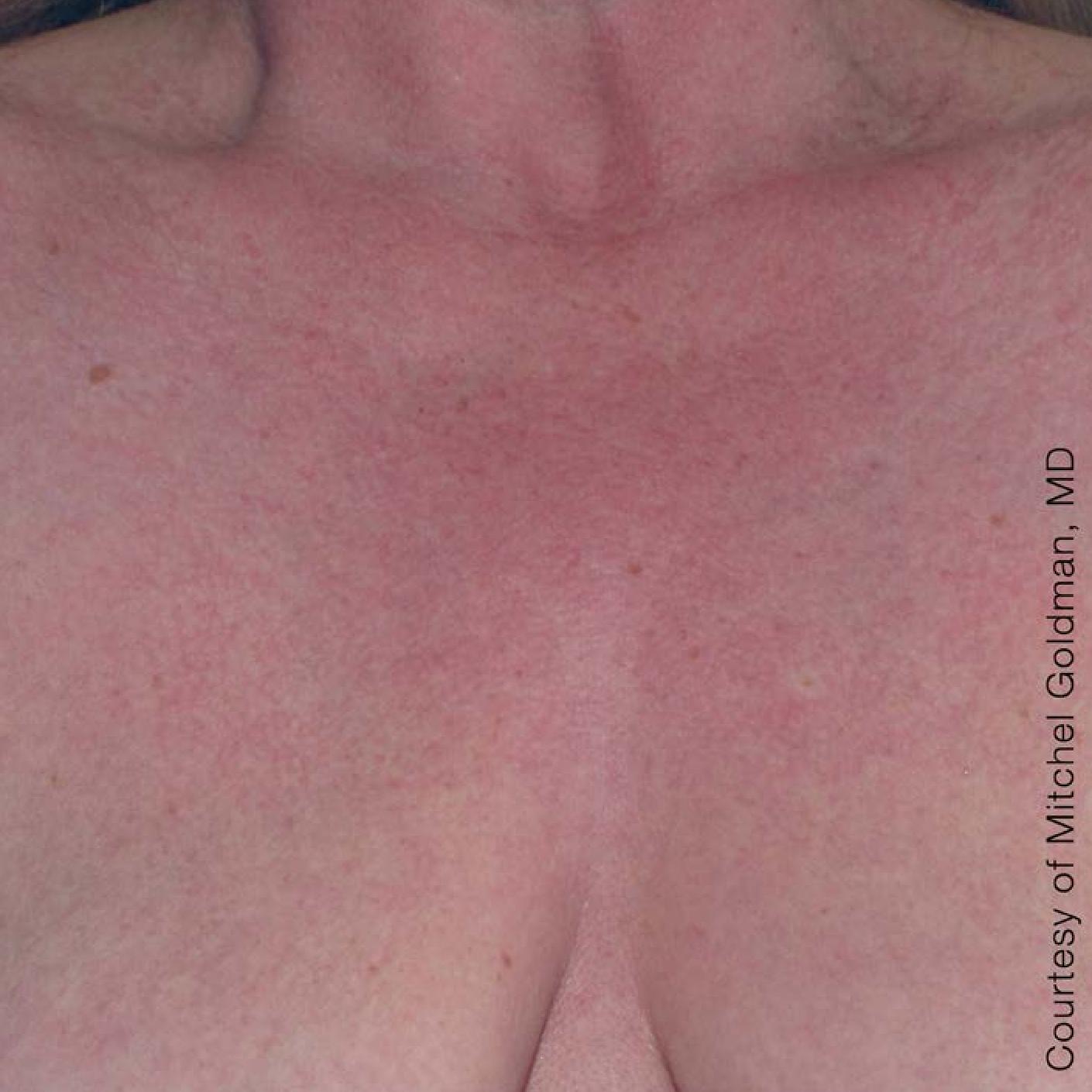 Ultherapy® - Décolletage: Patient 1 - After 1