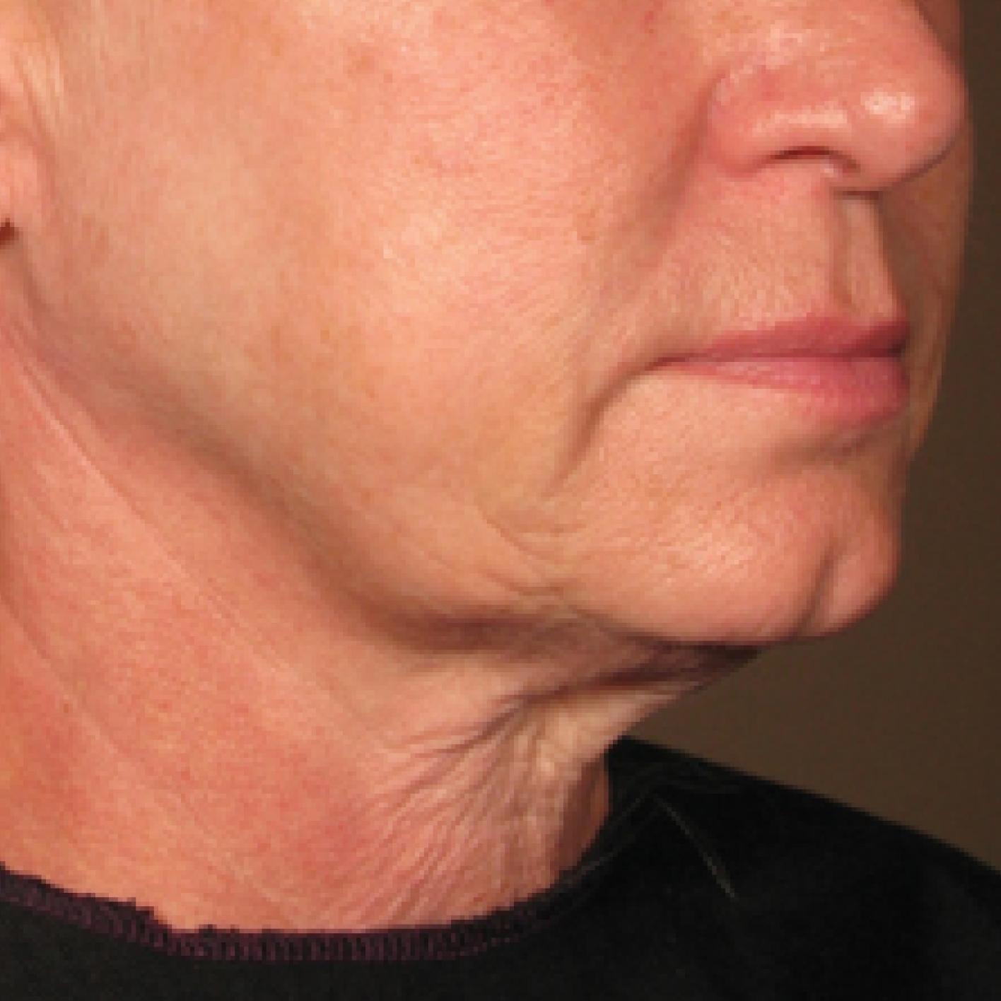 Ultherapy® - Chin: Patient 5 - After  