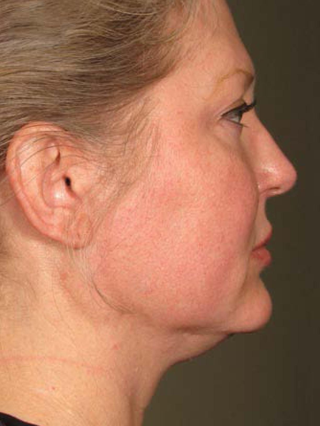 Ultherapy® - Face: Patient 6 - Before 1