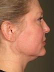 Ultherapy® - Face: Patient 6 - Before 