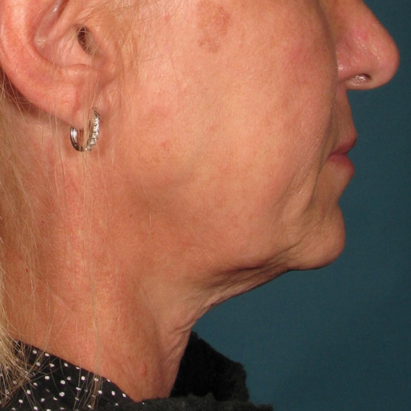 Ultherapy® - Chin: Patient 28 - Before 