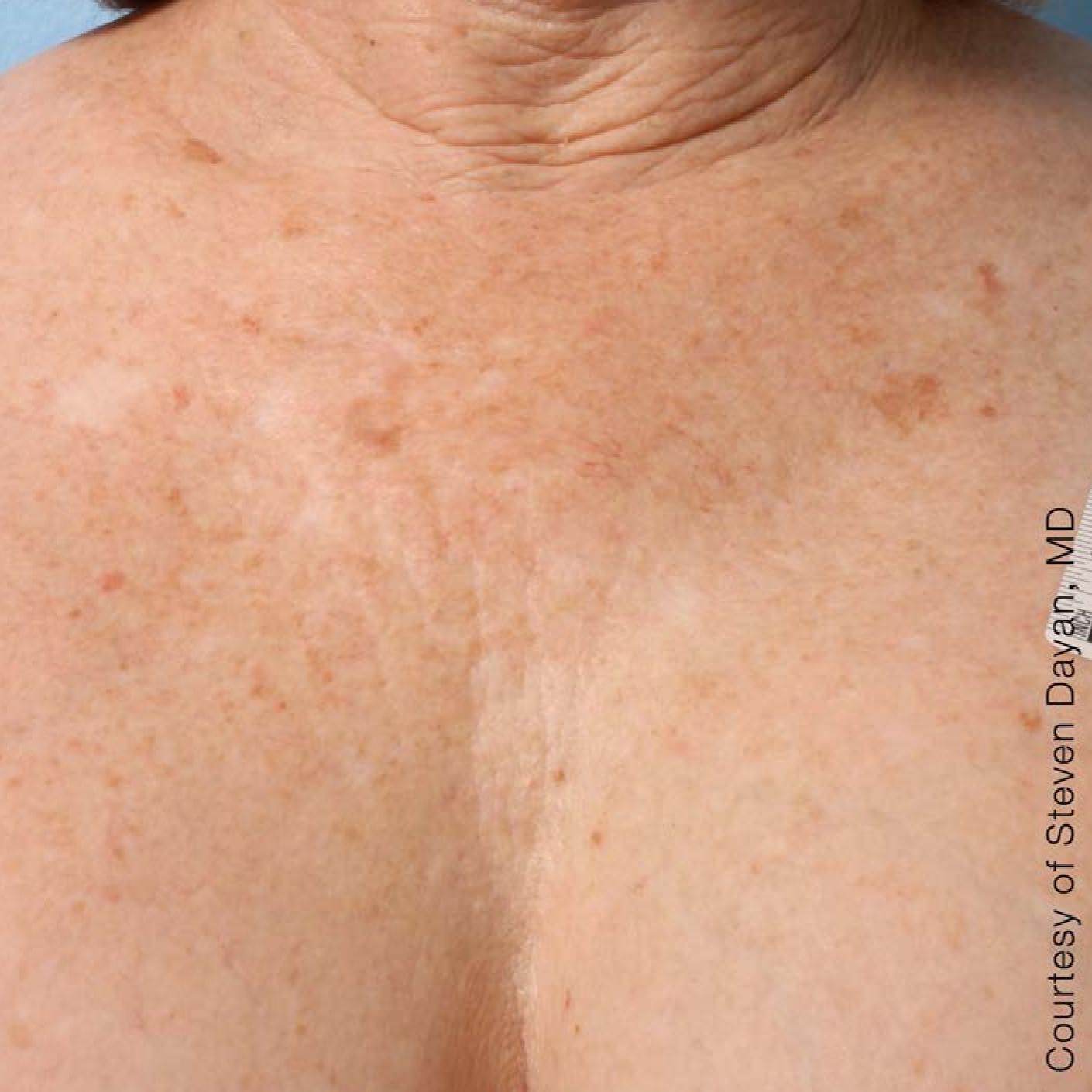 Ultherapy® - Décolletage: Patient 6 - After 1