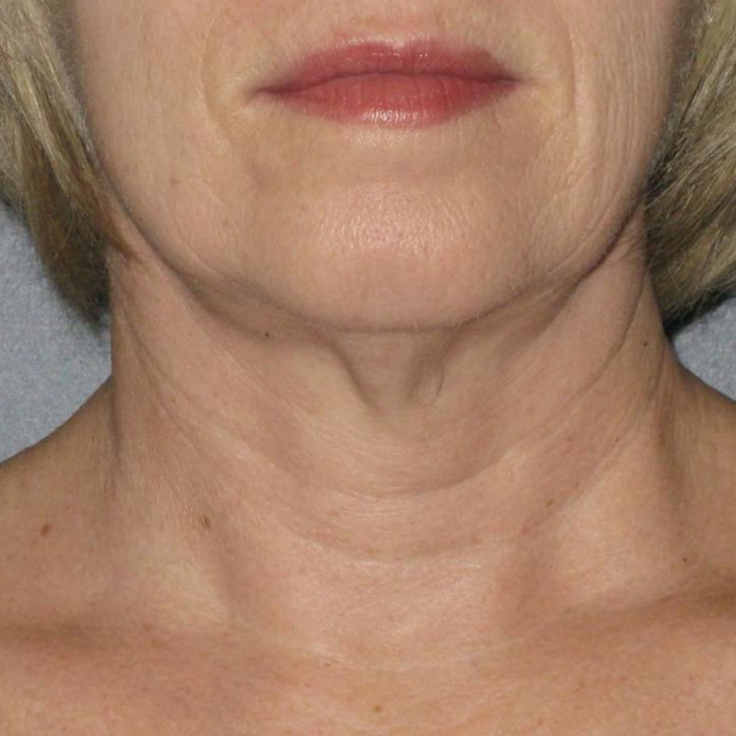 Ultherapy® - Neck: Patient 9 - Before 