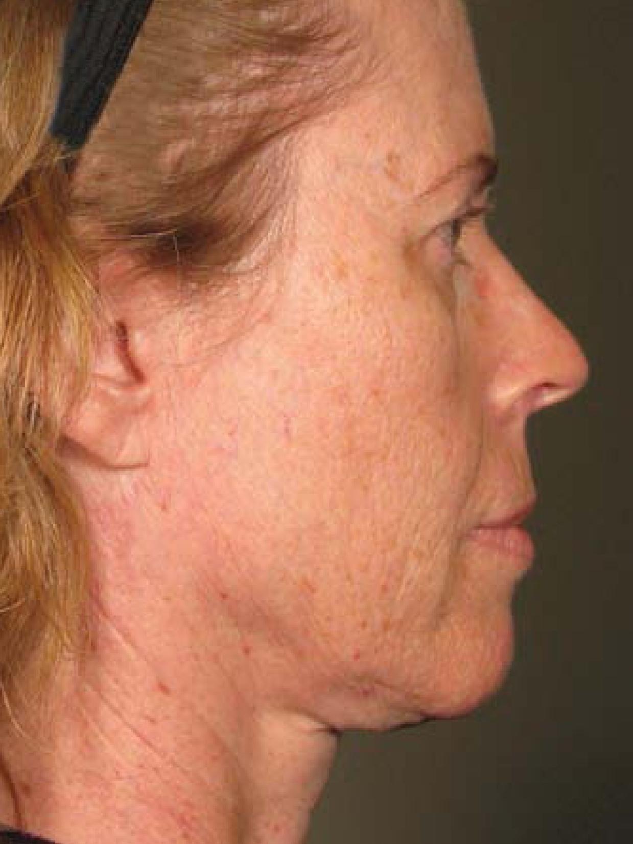 Ultherapy® - Face: Patient 20 - Before 