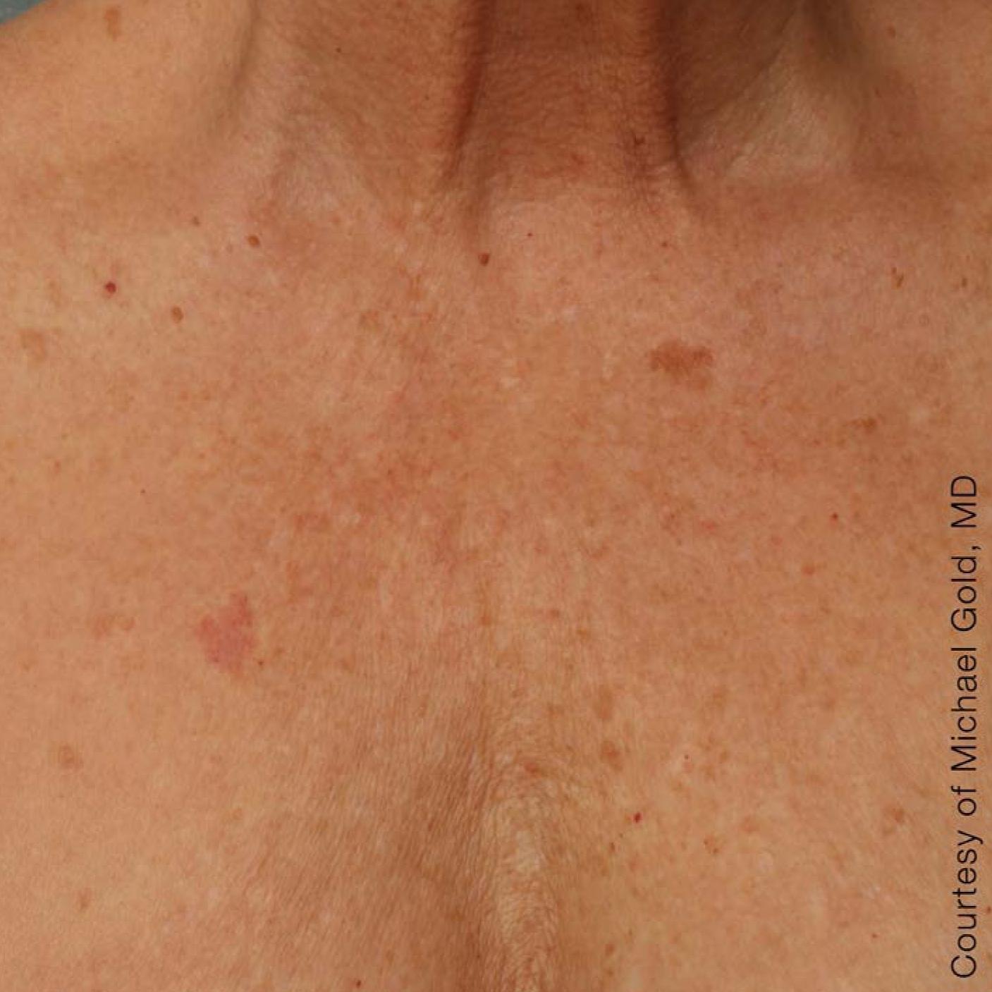 Ultherapy® - Décolletage: Patient 9 - After  